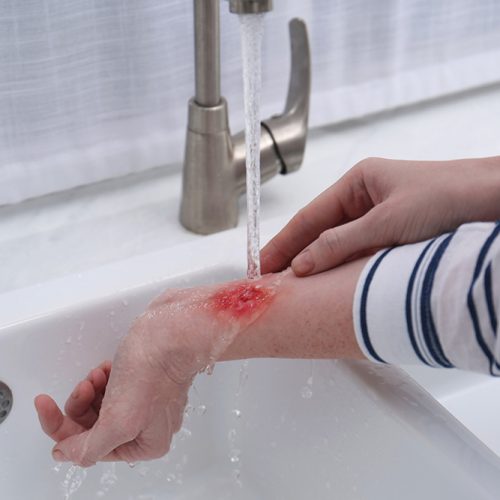 Person med sår på armen sköljer såret med vatten. Så tar du hand om brännskador